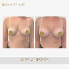 Aumento mamas - Dra. Micaela Taverna