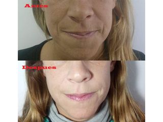 Rejuvenecimiento facial