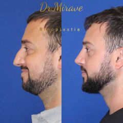 Rinoplastia - Dr. Gabriel Mirave