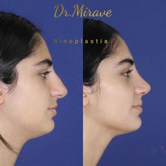 Rinoplastia - Dr. Gabriel Mirave