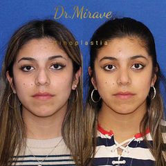 Rinoplastia - Dr. Gabriel Mirave