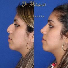 Rinoplastia - Dr. Gabriel Mirave