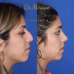 Rinoplastia - Dr. Gabriel Mirave