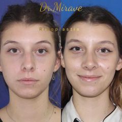 Rinoplastia - Dr. Gabriel Mirave