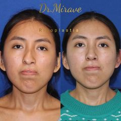 Rinoplastia - Dr. Gabriel Mirave