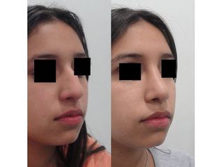 Rinoplastia