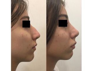 Rinoplastia