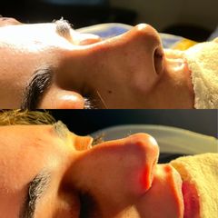 Rinoplastia - Dr. Ignacio Amado