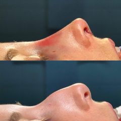Rinoplastia - Dr. Ignacio Amado