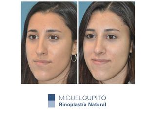 Rinoplastia - Dr. Miguel Angel Cupido