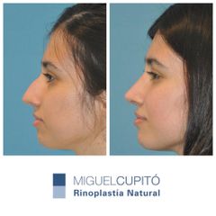 Rinoplastia - Dr. Miguel Ángel Cupito