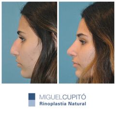 Rinoplastia - Dr. Miguel Ángel Cupito