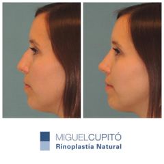 Rinoplastia - Dr. Miguel Ángel Cupito