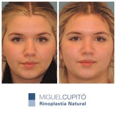 Rinoplastia - Dr. Miguel Ángel Cupito