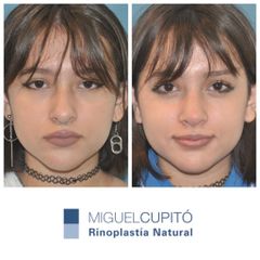 Rinoplastia - Dr. Miguel Ángel Cupito