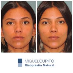 Rinoplastia - Dr. Miguel Ángel Cupito