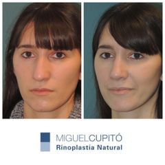 Rinoplastia - Dr. Miguel Ángel Cupito