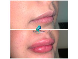Relleno de labios con acido hialuronico