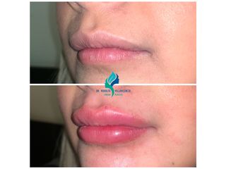 Relleno de labios con acido hialuronico