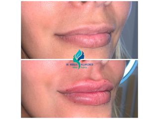 Relleno de labios con Ácido Hialuronico - Dr. Rodolfo Villavicencio