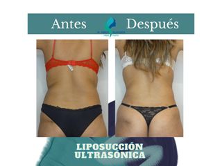 Liposucción ultrasónica - Dr. Rodolfo Villavicencio