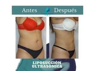 Liposucción ultrasónica - Dr. Rodolfo Villavicencio