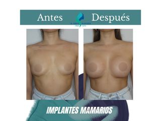 Pre y Postoperatorio de 3 semanas de implantes mamarios