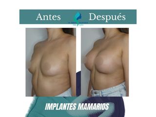 Pre y Postoperatorio de 3 semanas de implantes mamarios