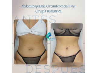 Dermolipectomia Circunferencial Post Cirugía Bariatrica - Dr. Rodolfo Villavicencio