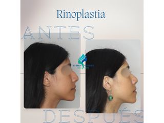 Rinoplastia - Dr. Rodolfo Villavicencio