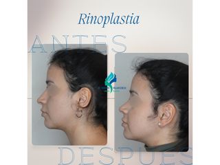 Pre y Postoperatorio de 1 mes de Rinoplastia