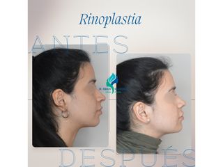 Pre y Postoperatorio de 1 mes de Rinoplastia
