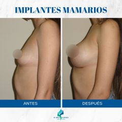 Aumento mamas - Dr. Rodolfo Villavicencio