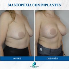 Mastopexia con Implantes - Dr. Rodolfo Villavicencioage 2024-05-21 at 21.06.18