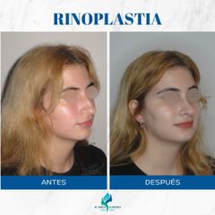 Rinoplastia - Dr. Rodolfo Villavicencio