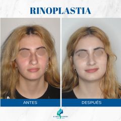 Rinoplastia - Dr. Rodolfo Villavicencio