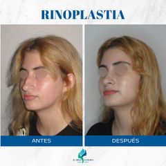 Rinoplastia - Dr. Rodolfo Villavicencio