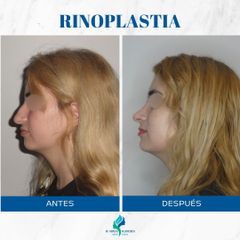 Rinoplastia - Dr. Rodolfo Villavicencio