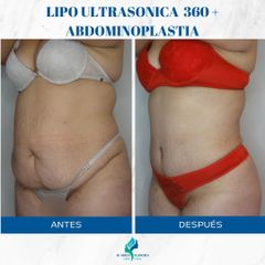 Abdominoplastia - Dr. Rodolfo Villavicencio