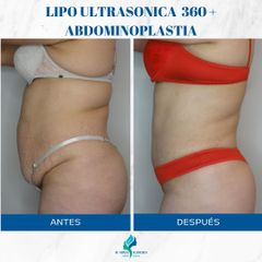 Abdominoplastia - Dr. Rodolfo Villavicencio