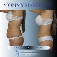 Abdominoplastia - Dr. Rodolfo Villavicencio