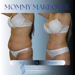 Abdominoplastia - Dr. Rodolfo Villavicencio