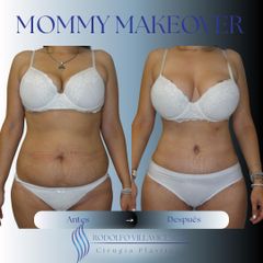 Abdominoplastia - Dr. Rodolfo Villavicencio