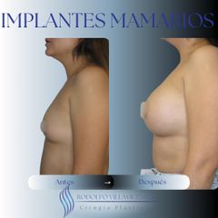 Aumento Mamario - Dr. Rodolfo Villavicencio