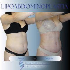 Lipoabdominoplastia - Dr. Rodolfo Villavicencio