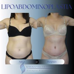 Lipoabdominoplastia - Dr. Rodolfo Villavicencio