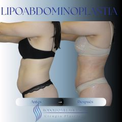 Lipoabdominoplastia - Dr. Rodolfo Villavicencio
