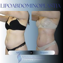 Lipoabdominoplastia - Dr. Rodolfo Villavicencio