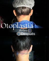 Otoplastia - Dr. Rodolfo Villavicencio