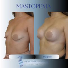 Mastopexia - Dr. Rodolfo Villavicencio